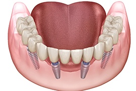 3D render of All-on-4 dental implants