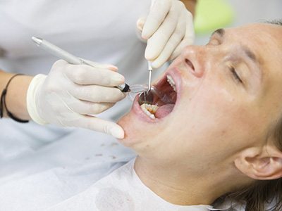 Up-close view of patient having their teeth cleaned
