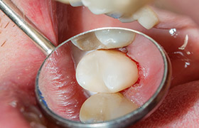Closeup of tooth after dental bonding