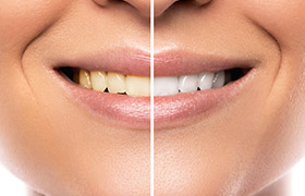 Closeup of teeth half before and half after whitening