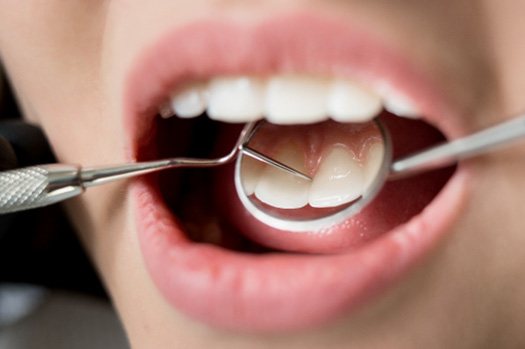 Closeup of someone’s teeth being examined with mirror and dental instrument