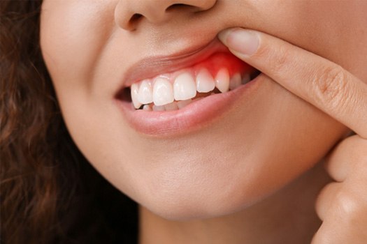 Nose-to-chin closeup of woman using one finger to pull back upper lip to reveal dark gums