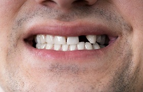 Patient with a missing tooth