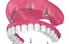 implant denture on the upper arch 