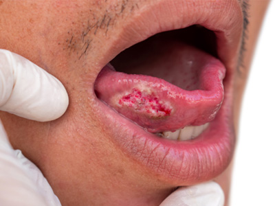 Signs and symptoms of oral cancer include sores or ulcers on the tongue