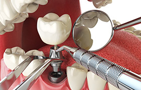 Animation of implant supported dental crown placement