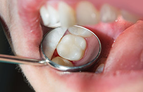 Closeup of smile after dental restoration