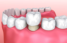 Animation of dental crown placement