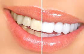 before and after teeth whitening in Beverly