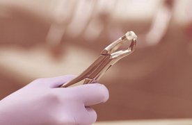 Dentist using forceps to hold wisdom tooth in Beverly