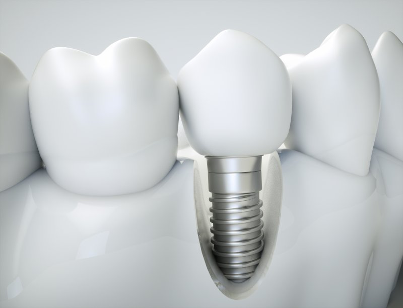 3-D model of a dental implant