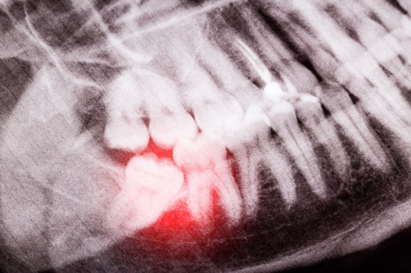 X-ray of wisdom tooth growing sideways